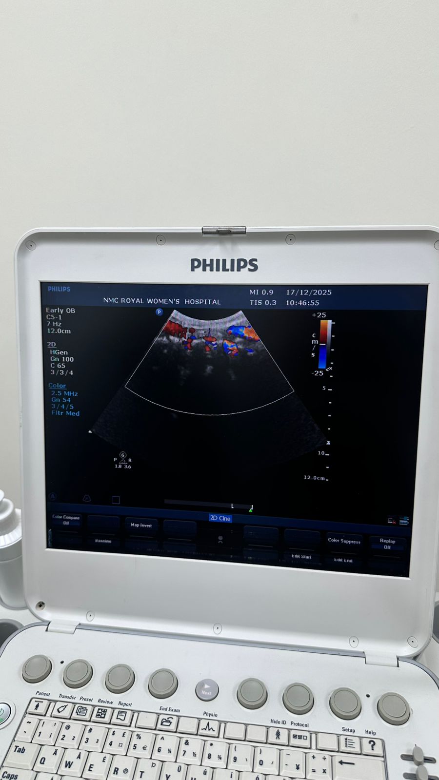 Philips CX50 portable ultrasound with convex and TVS probe