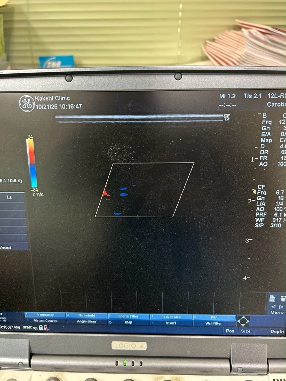 GE LOGIQ e Rev 2 Portable ultrasound