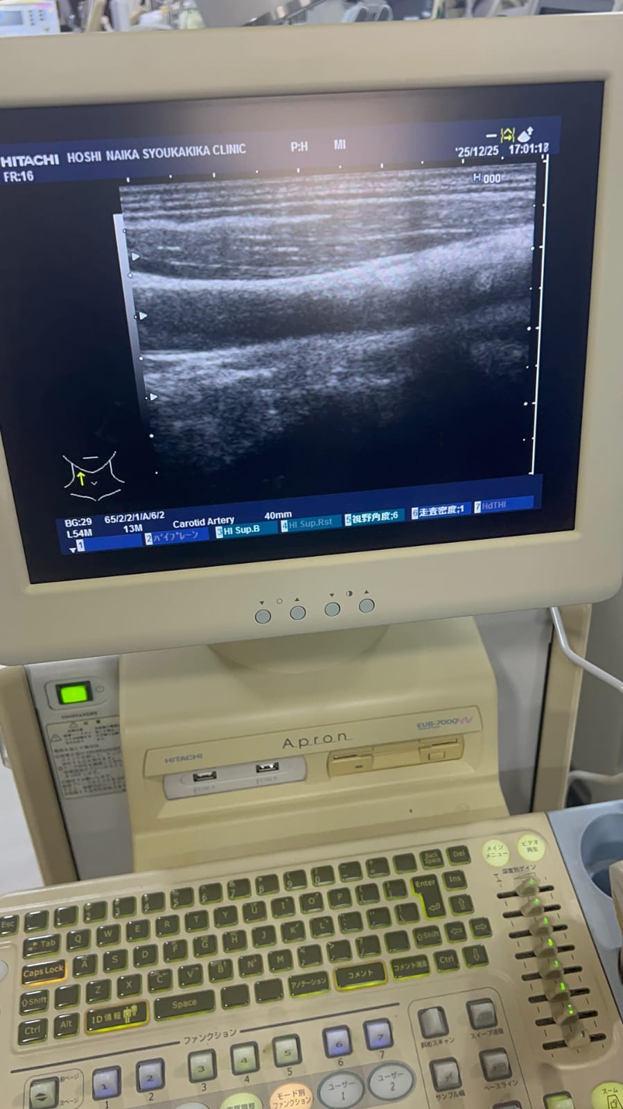 Hitachi apron ultrasound with convex and linear probe
