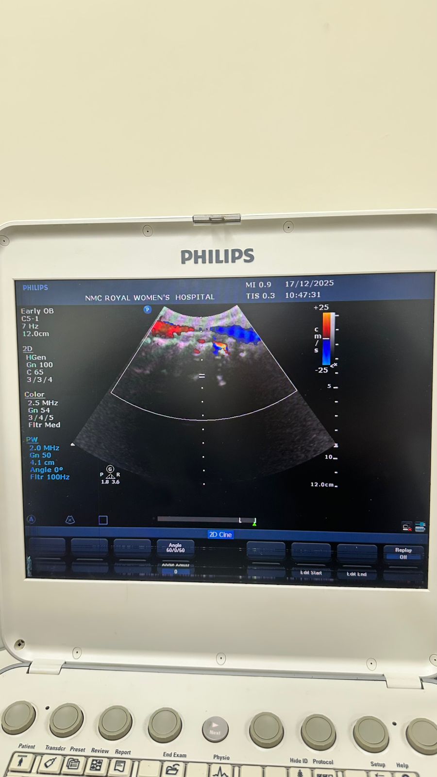 Philips CX50 portable ultrasound with convex and TVS probe