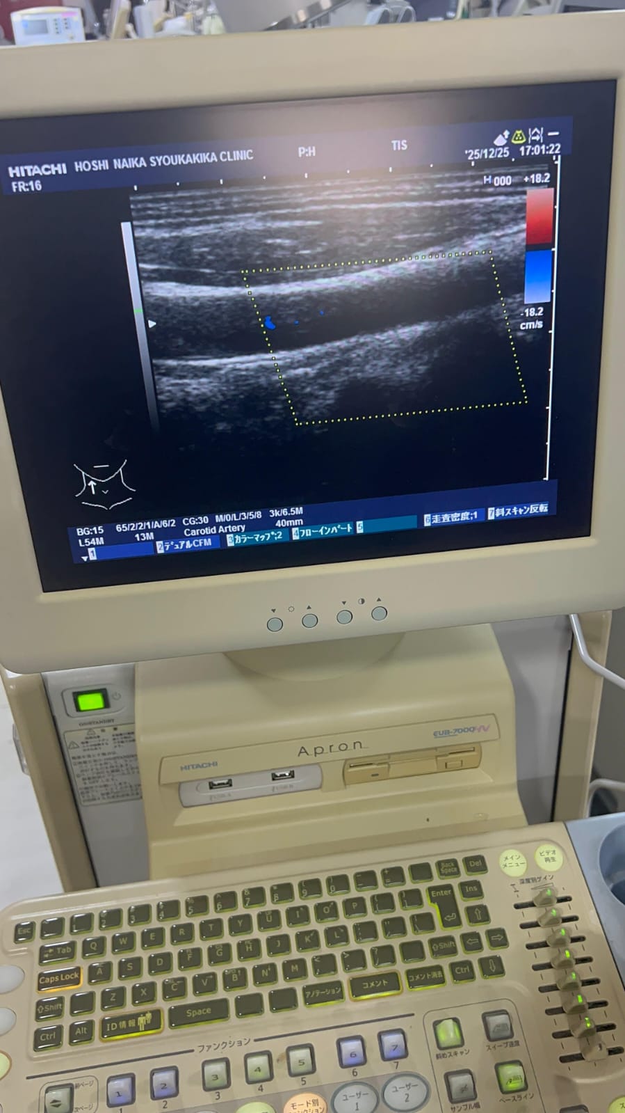 Hitachi apron ultrasound with convex and linear probe