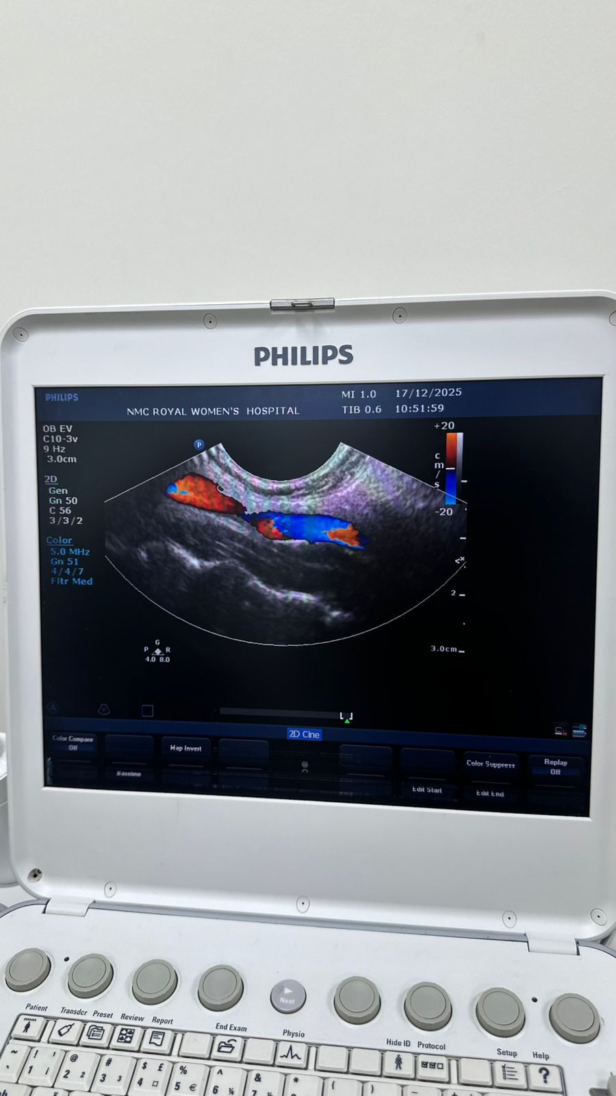 Philips CX50 portable ultrasound with convex and TVS probe