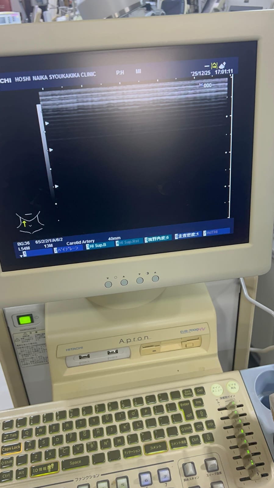 Hitachi apron ultrasound with convex and linear probe