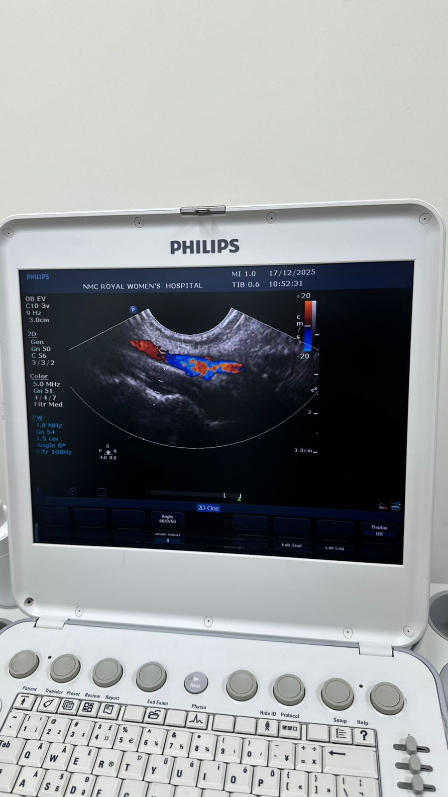 Philips CX50 portable ultrasound with convex and TVS probe