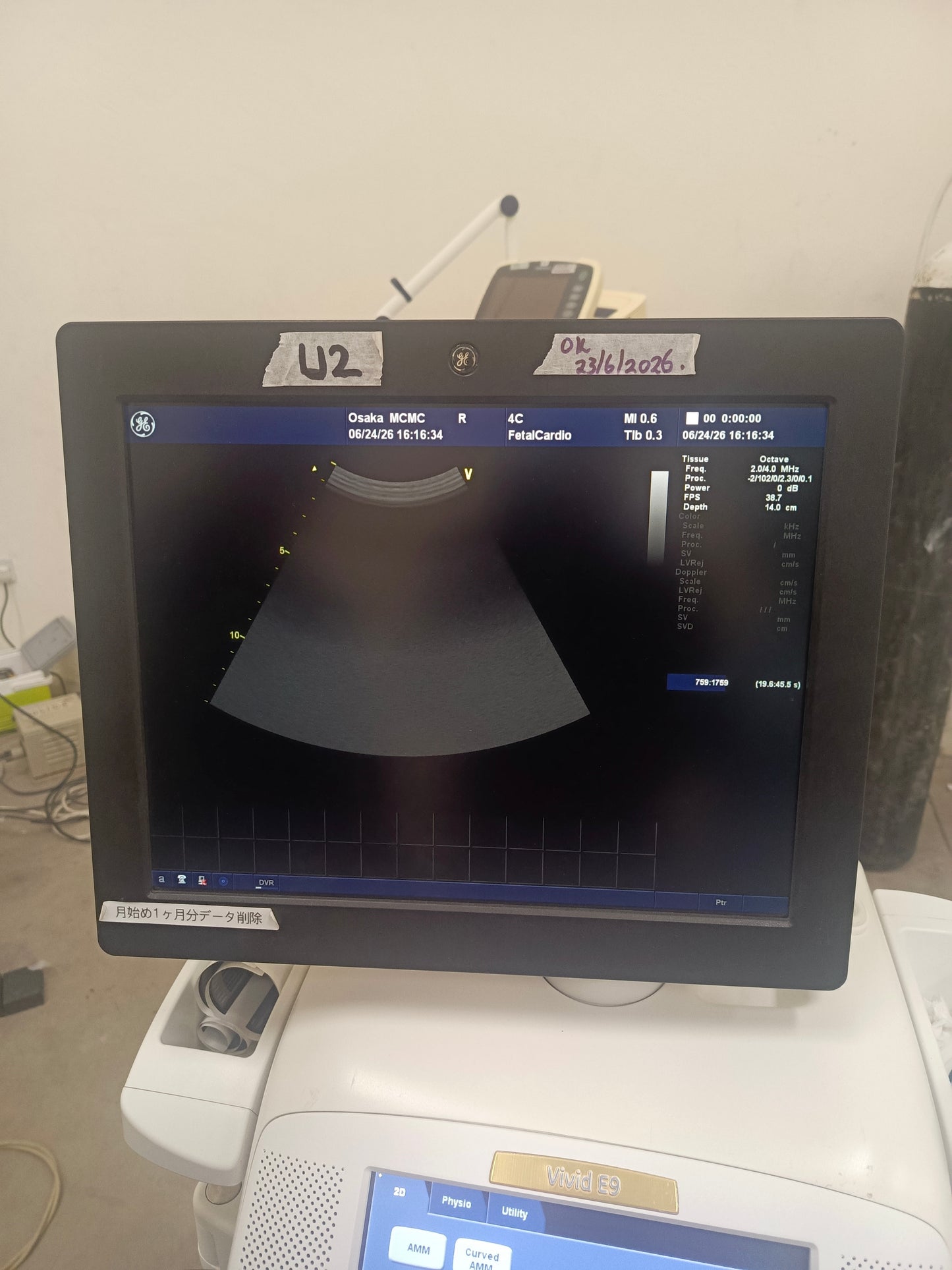 GE ultrasound vivid E9 with a convex probe