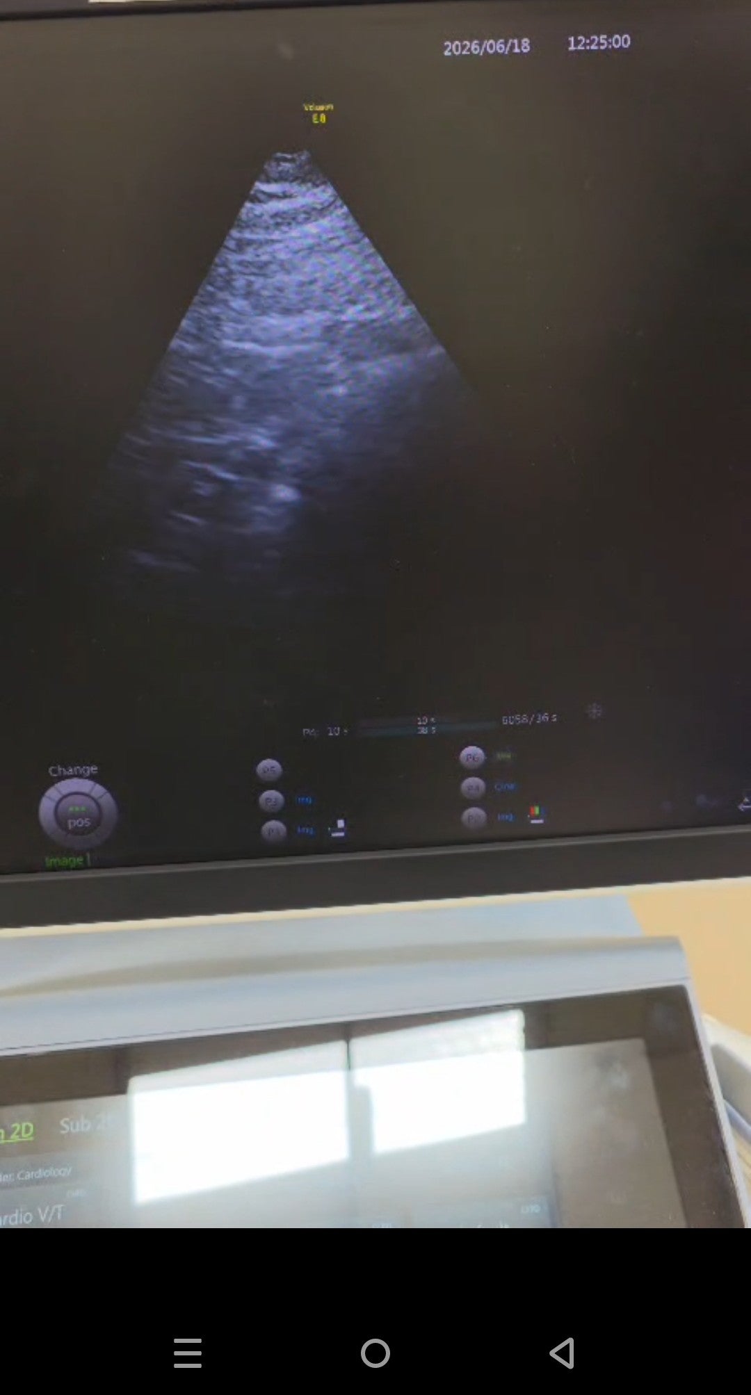 GE S4-10-D Sector Array Probe for Ge voluson E8, E10 ultrasounds BH