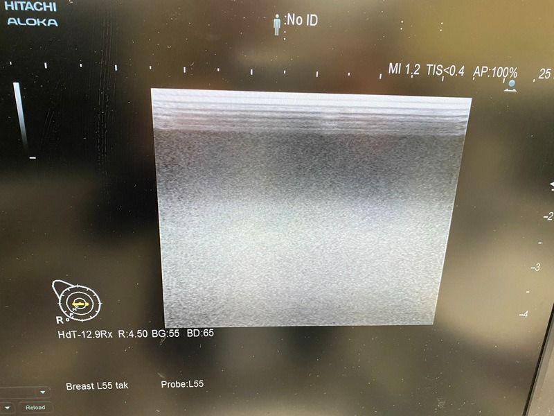 Hitachi Arreita 70 with 4 Probes Ultrasound (Refurbished equipment)