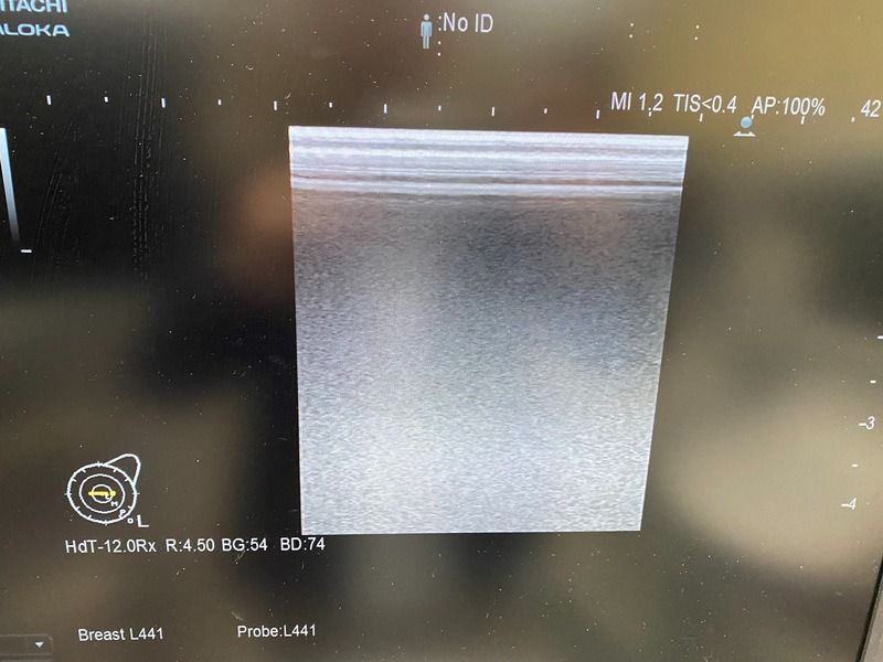 Hitachi Arreita 70 with 4 Probes Ultrasound (Refurbished equipment)