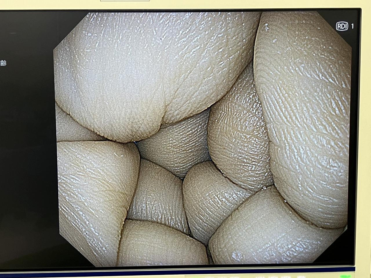 Olympus EVIS X1 CV-1500 Endoscopy Processor