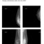 MSLRX13 Digital Mammography System – High Frequency 6kW Breast Imaging Unit with Flat Panel Detector