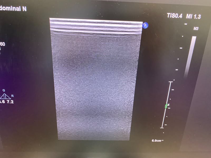 PHILIPS AFFINITI 70G With Convex, Linear and Cardiac refurbished equipment
