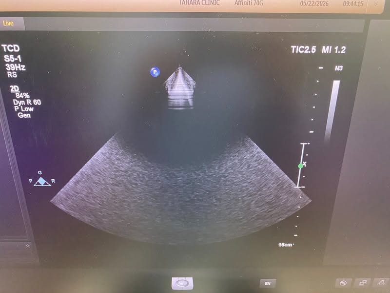 PHILIPS AFFINITI 70G With Convex, Linear and Cardiac refurbished equipment